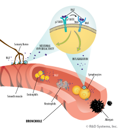 Allergic Ashtma