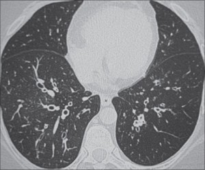 radiologic spectrum of ILD